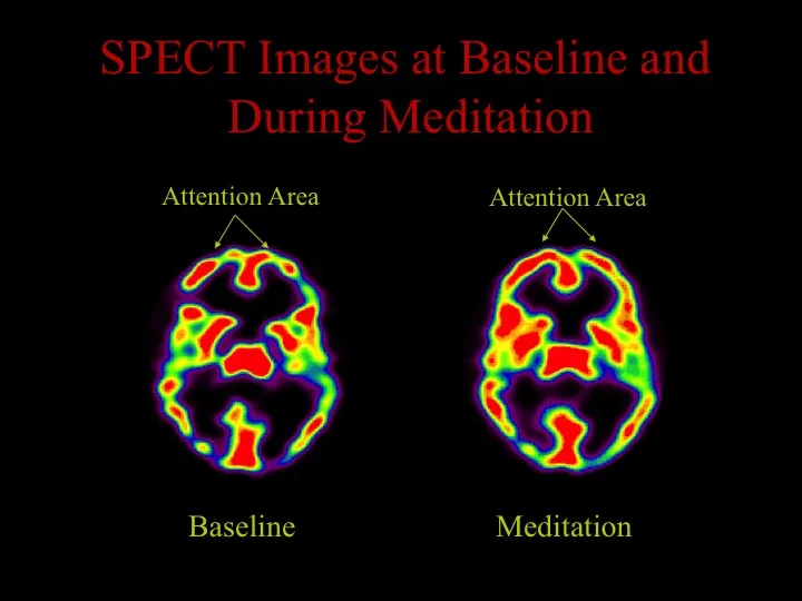 02-spect-images-at-baseline-and-during-meditation